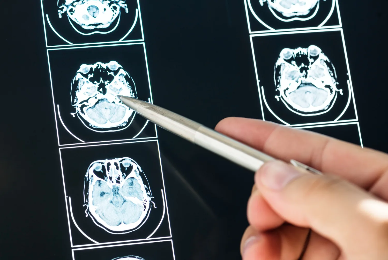 Hematoma subdural en CDMX: diagnóstico, tratamiento y seguimiento