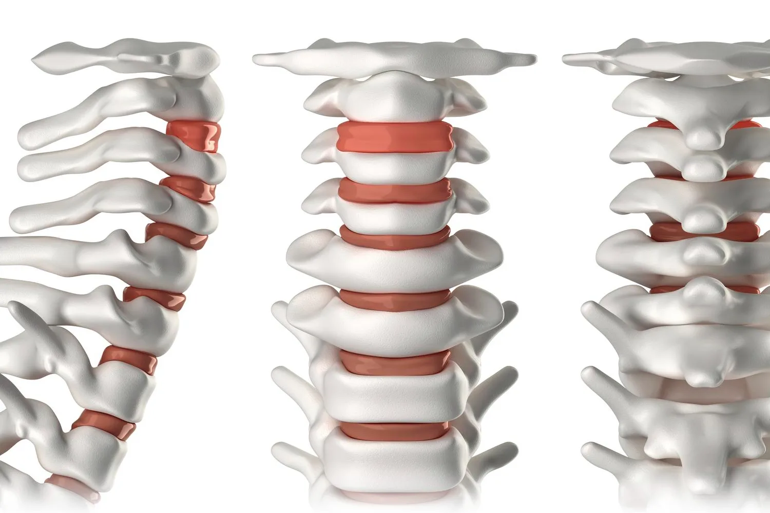 Hernia de disco lumbar en CDMX: diagnóstico, tratamiento y opciones quirúrgicas